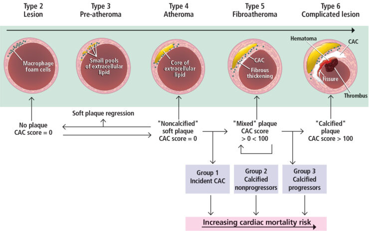 coronary artery calcium (CAC) score